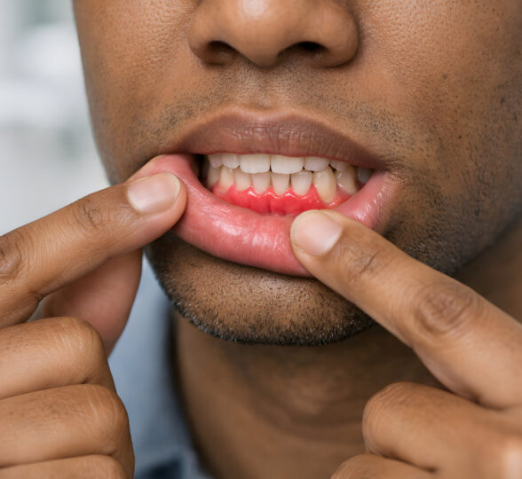 Close-up illustrating gum recession